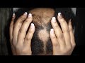 My Journey | Curing Alopecia Areata N A T U R A L L Y ! *(pics included)*