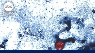 Cyclosporiasis outbreak raises new food safety concerns