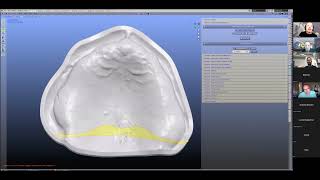 ZOOM Denture Module Beta Preview