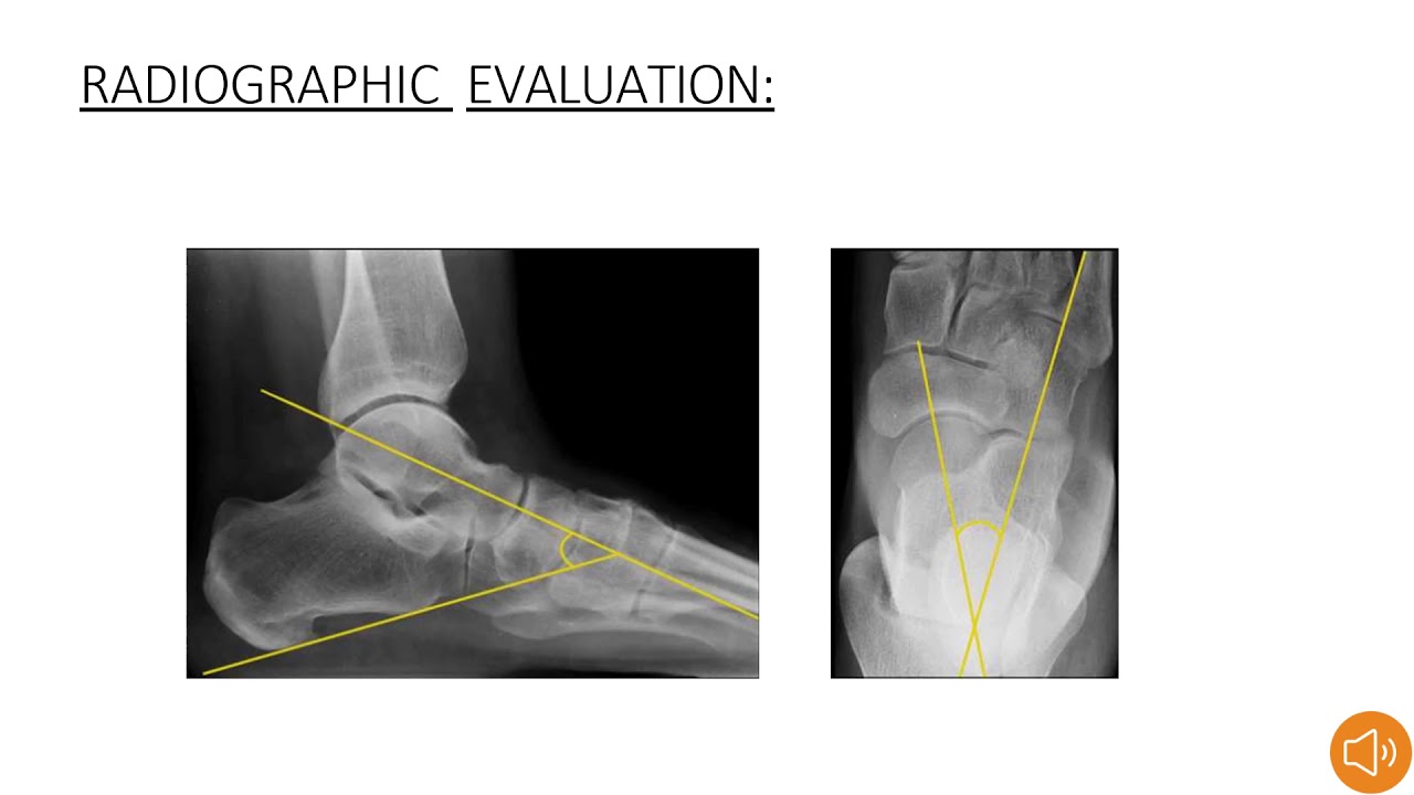 Congenital talipes equino varus by Dr. Dhruvin Patel YouTube