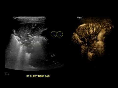 Image of Consolidation vs Pleural Effusion