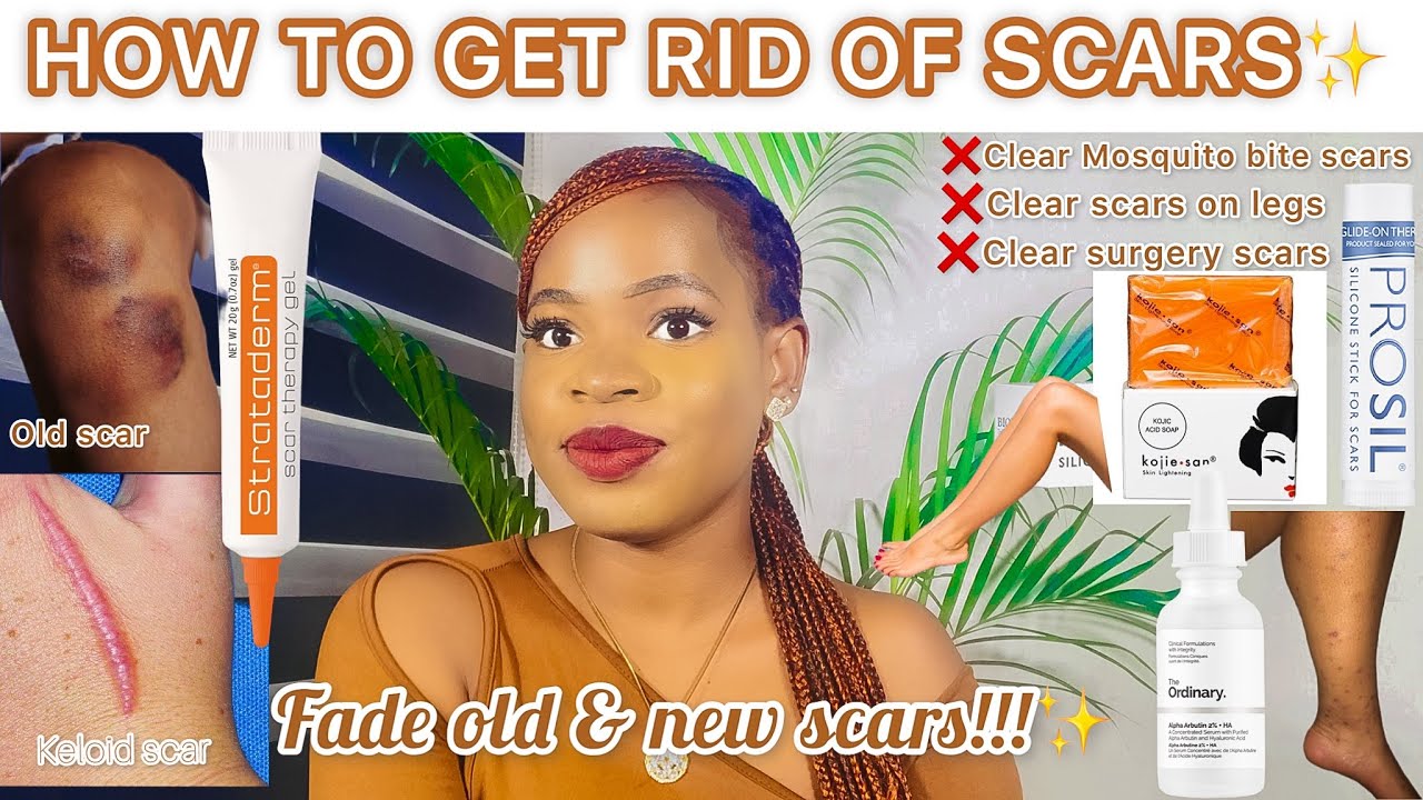 HOW TO GET RID OF SCARS* *Mosquito Bites*|*Scars On Legs*|*Surgery Scars*|*Old  Scars* +*Fade Scars* - YouTube