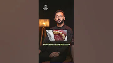 جيوب الأسنان عبارة عن إيه و إزاي أعالجها 