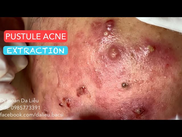 Cystic Acne Extractions