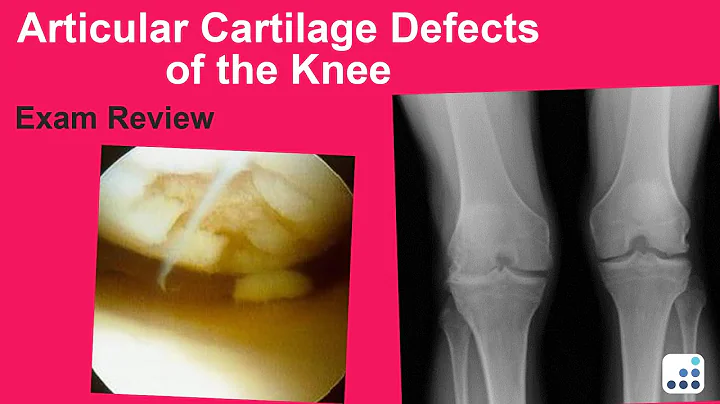 Articular Cartilage Defects of the Knee Exam Revie...