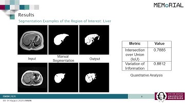 Unsupervised learning for Abdominal MRI Segmentation using 3D Attention W-Net