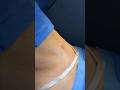 LIPOABDOMINOPLASTIA #drbernardobastian #cirurgiaplasticarj #lipoaspiração
