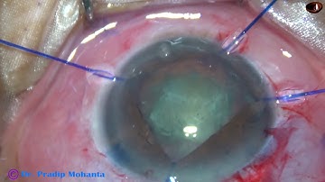 Small-pupil-Phaco using 