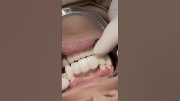 Zirconia bridge to replace missing teeth #satisfying