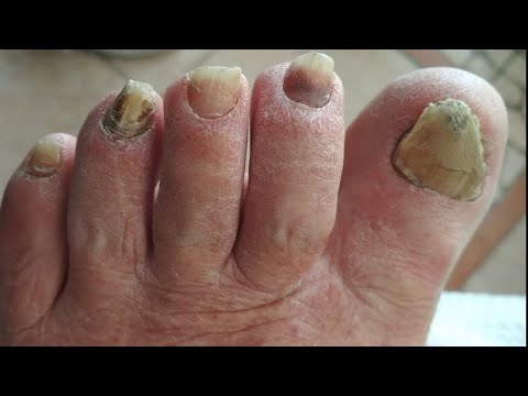 Therapeutic Pedicure-Fungus/ Θεραπευτικό Πεντικιούρ -Μύκητες /Терапевтичен Педикюр- Elizabeth Veleva