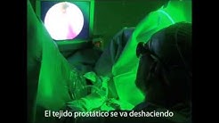 hospital bari urología resección láser de próstata de