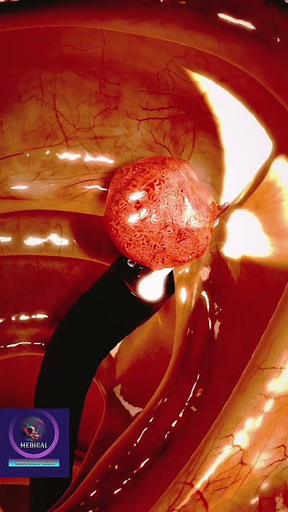 Colon Polyp Removal - 3D Animation