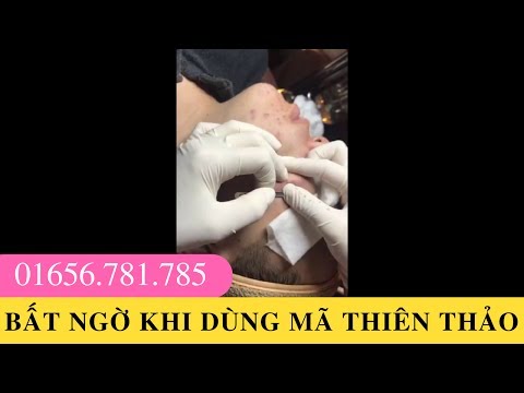 Lấy nhân mụn sau 2 tháng dùng Thuốc Trị Mụn Nặng Mã Thiên Thảo D'Vi Beauty