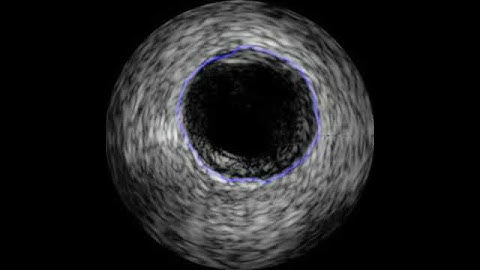 External Elastic Luminae Segmentation