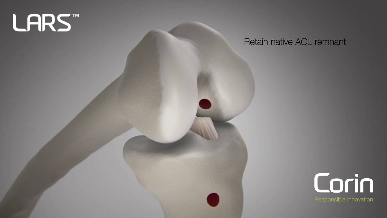 Ligament Augmentation and Reconstruction System (LARS) - Physiopedia