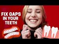 How to Close Gaps in Teeth 2021