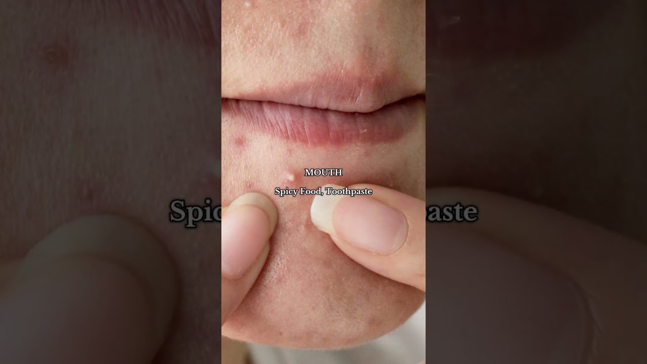 What Different Acne Spots Say About Your Skin! Face Mapping Explained! 🚨