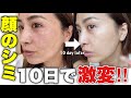 【シミ治療】43歳フォトフェイシャルで美肌✨ 10日間でここまで変わった経過を見せます。【美容医療】