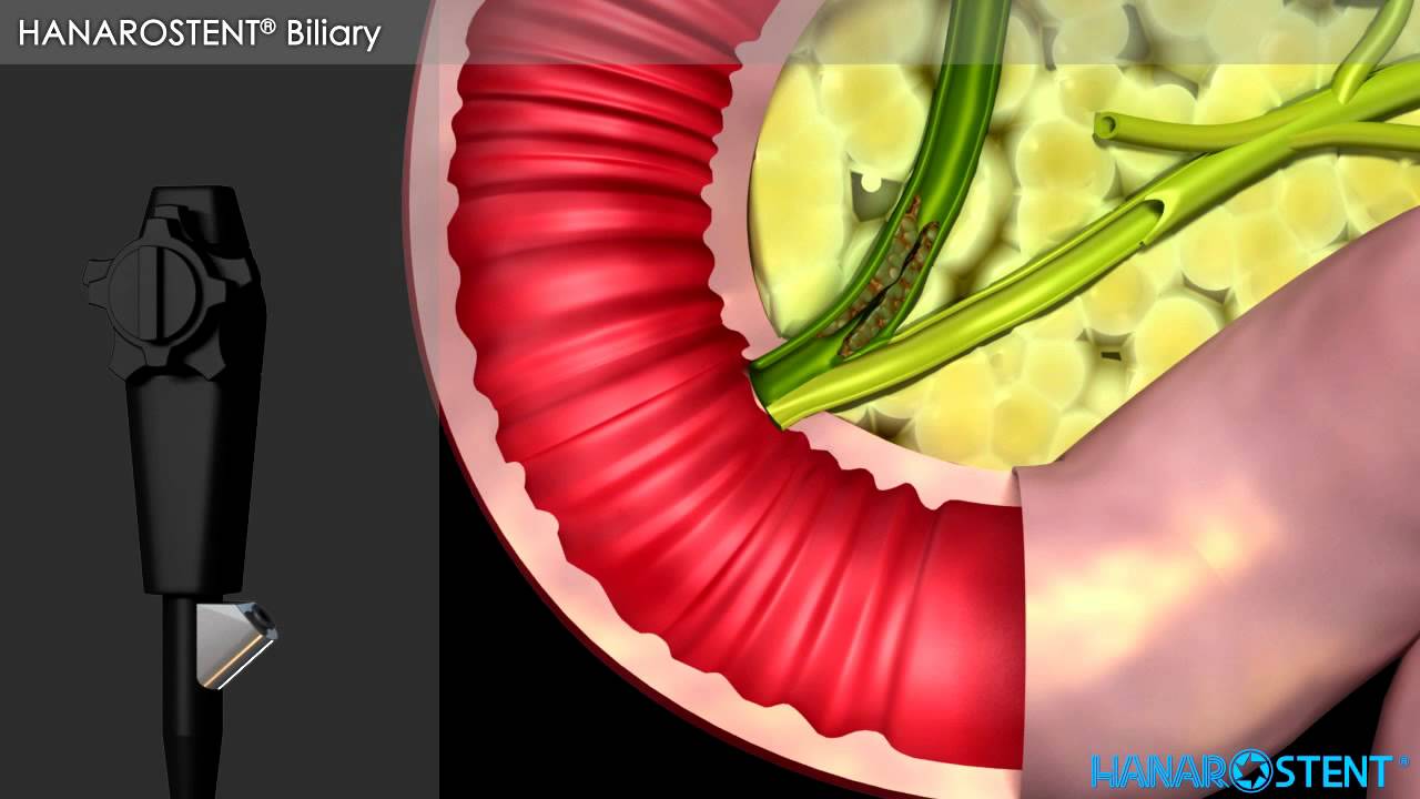 hanaro-biliary-stents-demonstration-video-youtube
