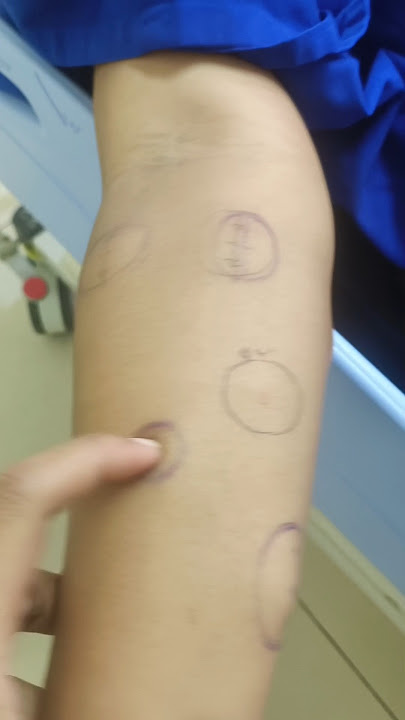 multiple lipoma di tangan #devifebriani #kamaroperasi #lipoma #tumorjinak