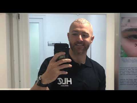 Hair Transplant Journey: Procedure Day 1&2 - HLC Ankara