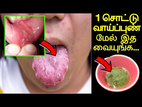 இத வச்சா வாய்ப்புண் 3 நிமிடத்தில் ஆறிவிடும் | vai punn aara | vai pun aara marunthu in tamil