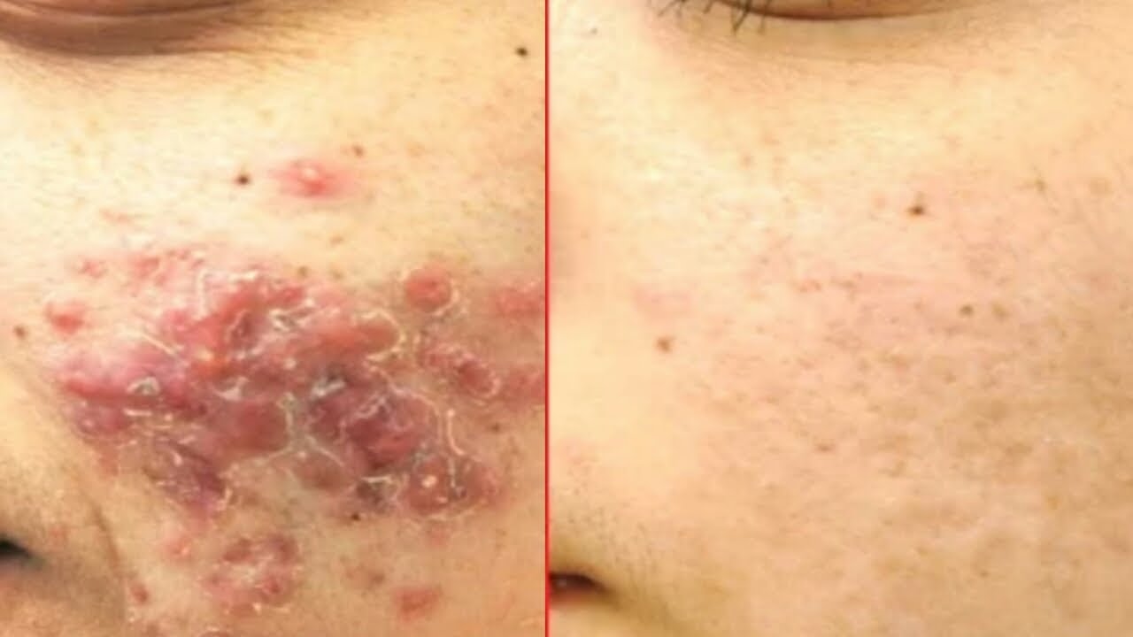 How To Remove pimples Acne Overnight Treatment 7 Day's Challenge - YouTube