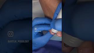 Обработка всех ногтей #онихомикоз #подолог #nailsnewyork #pedicurenewyork #pedicurebrooklyn #podolog