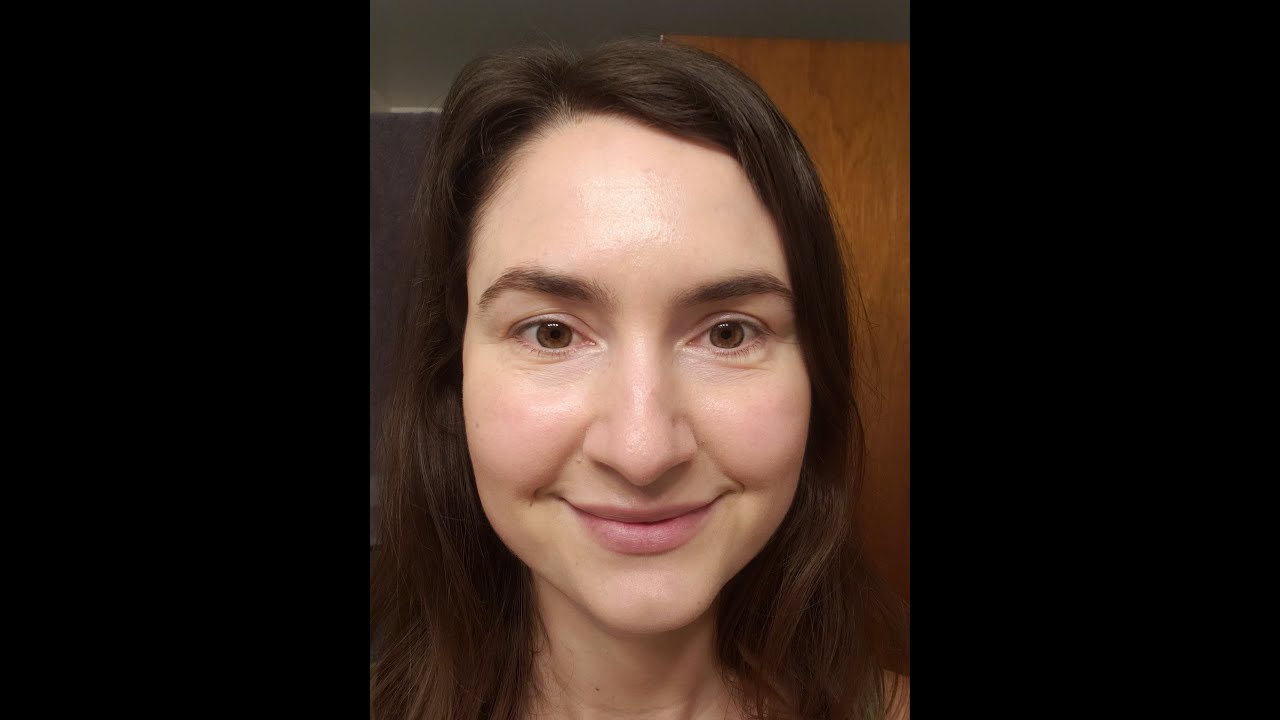 Rosacea Flare Up Care Live In the Moment