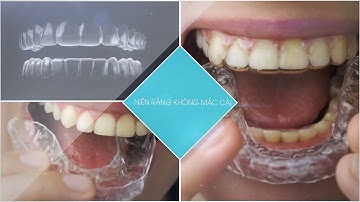 Những Thuận Tiên Khi Niềng Răng Không Mắc Cài