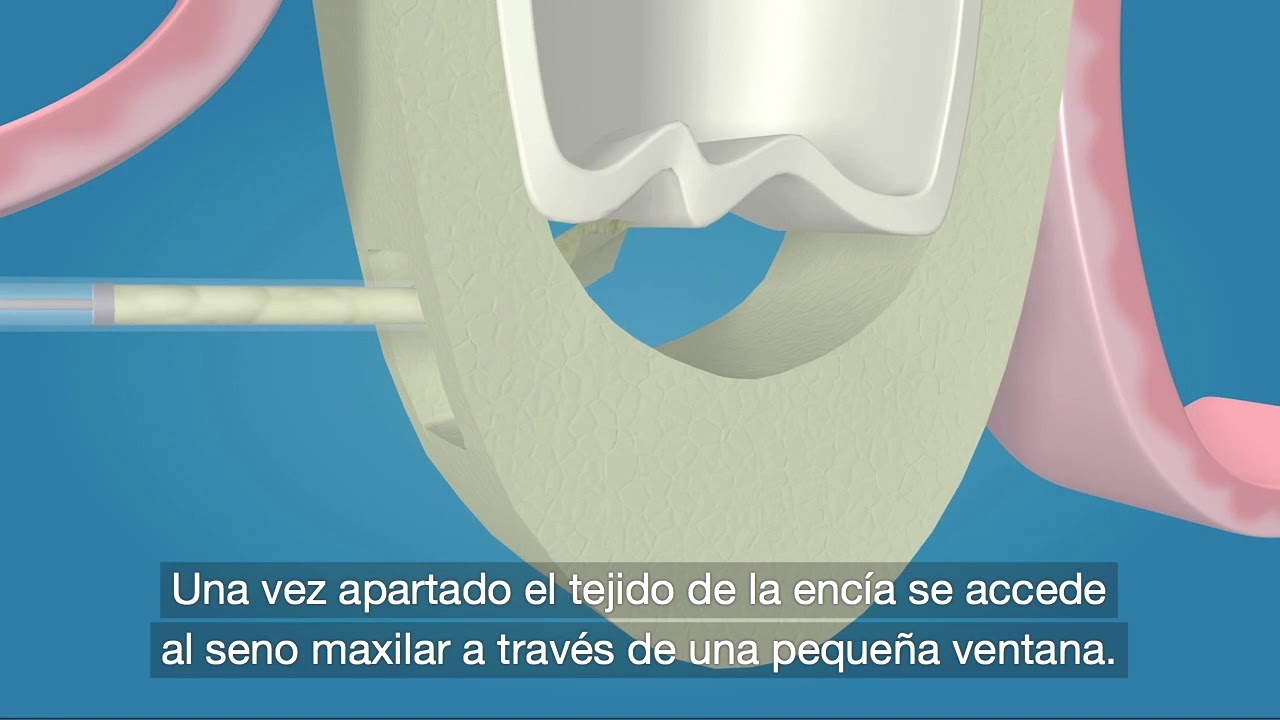 Elevación de Seno Maxilar  Clínica Dental MiBO Almería 