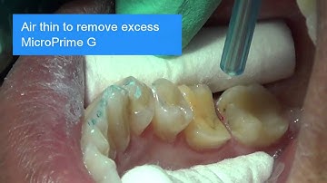 Immediate Dentin Sealing Technique