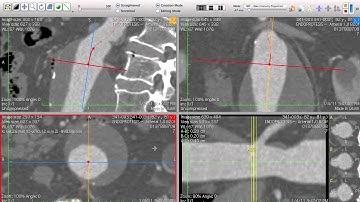 EVAR Planning - Centerline for Aortic & Total Length - How I do it with Osirix