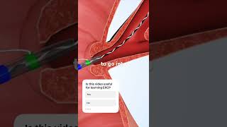 ERCP selective CBD cannulation technique #doctor #hospital #medicalstudent