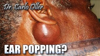 Popping Ear Zit? Earring Removal Surgery