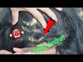 Psoriasis treatment, Dandruff Removal, Itchy Scratching, Huge Flakes, Part 160