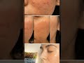 Arbi Herbal Anti Acne KitYour true friend for glowing skin #acne #blackheads #whitehead #pigmentatio