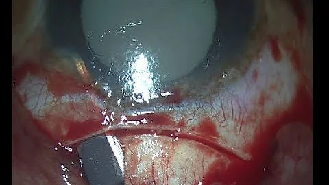 MSICS white cataract Soosan Jacob with audio 2 45 ...
