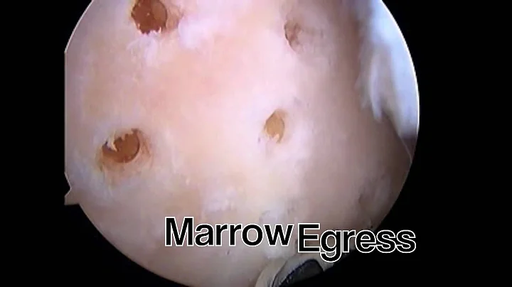 Arthroscopic MicroFracture Trochlear Groove by Cha...