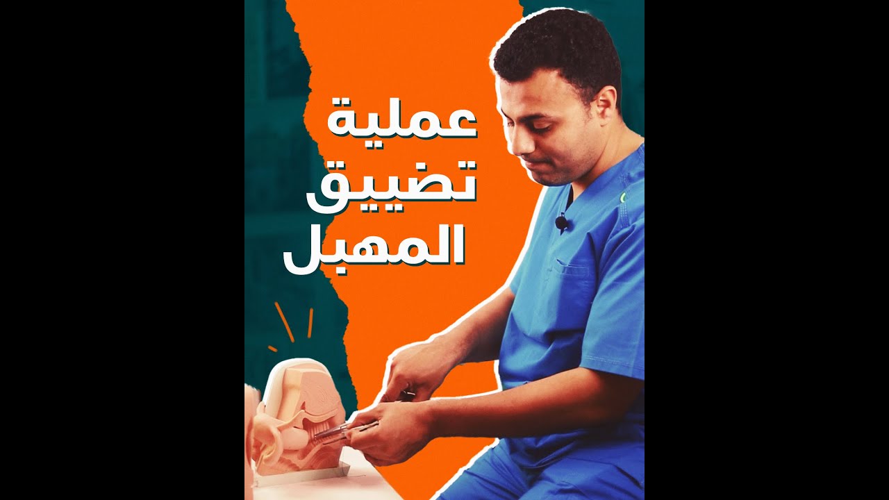 عملية التضييق