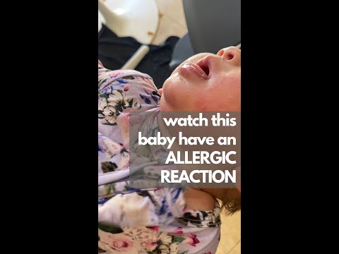 Video: Çocuk Peanut Allergy için A Cure bulundu mu?