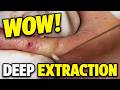 WOW! Deep Pore Extraction You Need to See!
