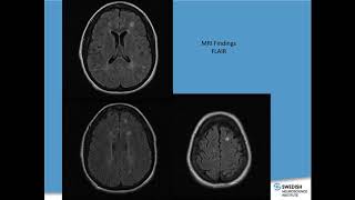 MS 101 - James Bowen, MD - October 2018