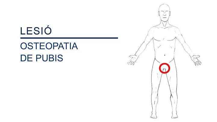 OSTEOPATIA PUBIS o PUBALGIA [JOS ARAGON] #6: QU NO...