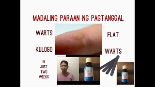 Paano Matanggal Ang Kulugo? | DIY Warts Removal On Easy Steps Paano Matanggal Ang Kulugo? | DIY Warts Removal On Easy Steps