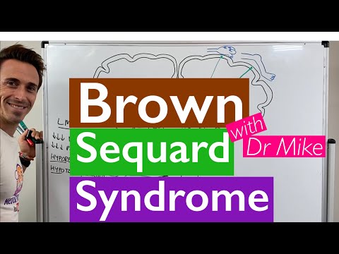 Brown Sequard Syndrom