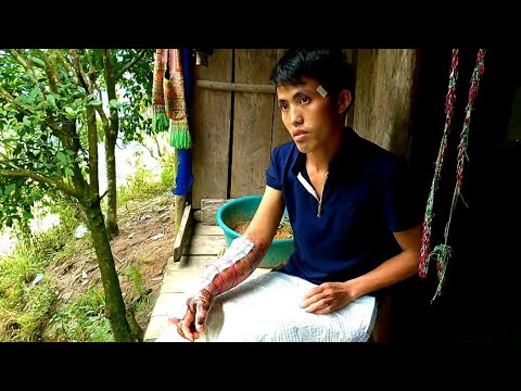 Video A Tráng bị rắn Mốc cắn tay hoại tử nguy cơ tháo khớp. - youtube