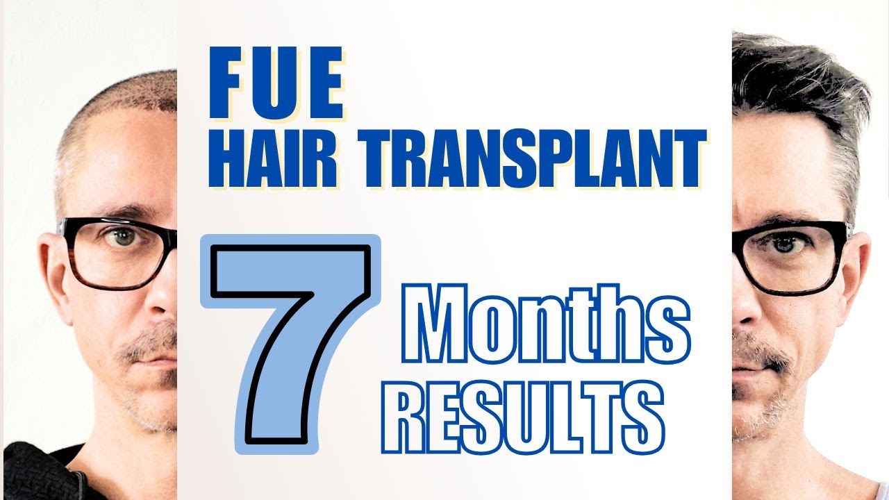 FUE Hair Transplant at Cosmedica Istanbul - 7 Months Results