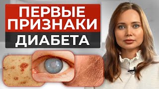 Вы подвержены САХАРНОМУ диабету, если… / Проверьте себя на ЭТИ 6 симптомов