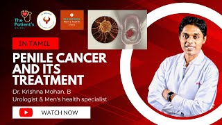 Penile cancer I Diagnosis and Treatment I Explained by Urologist and Men's health specialist I Tamil